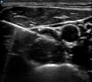 Navigating the Intricacies of Stellate Ganglion Block in the Bay Area: A Year’s Reflection on Stellate Ganglion Nerve Block for Anxiety, PTSD, and Long Covid Treatments